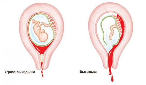 Угрожающий аборт и самопроизвольный выкидыш