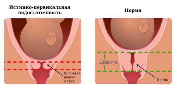 Истмико-цервикальная недостаточность