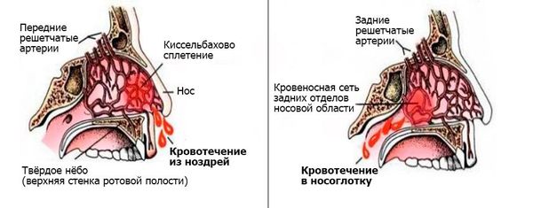 Носовое кровотечение