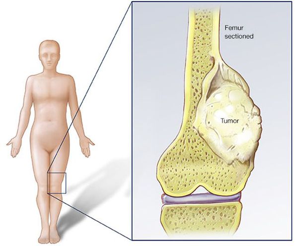 Опухоль кости