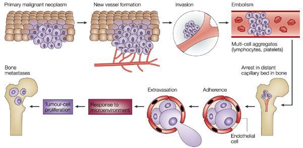 Метастазирование опухоли в кость