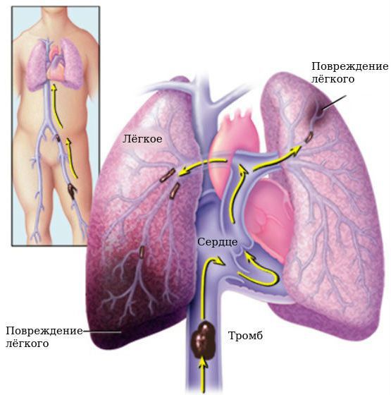 Тромбоэмболия лёгочной артерии