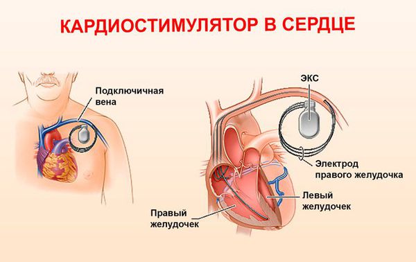 Электрокардиостимулятор