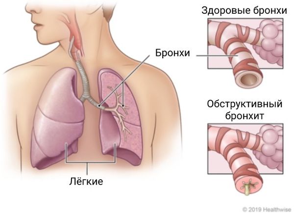 Обструктивный бронхит