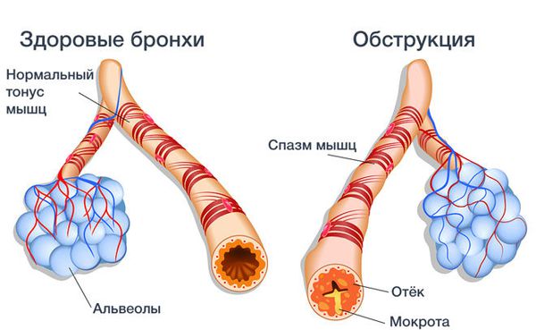 Появление гноя в бронхах