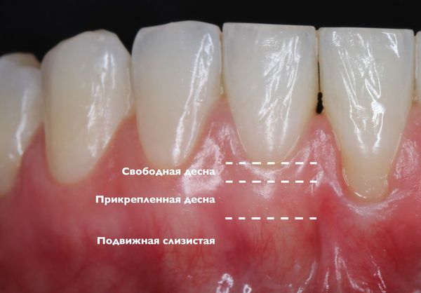 Строение десны. Прикреплённая кератинизированная десна