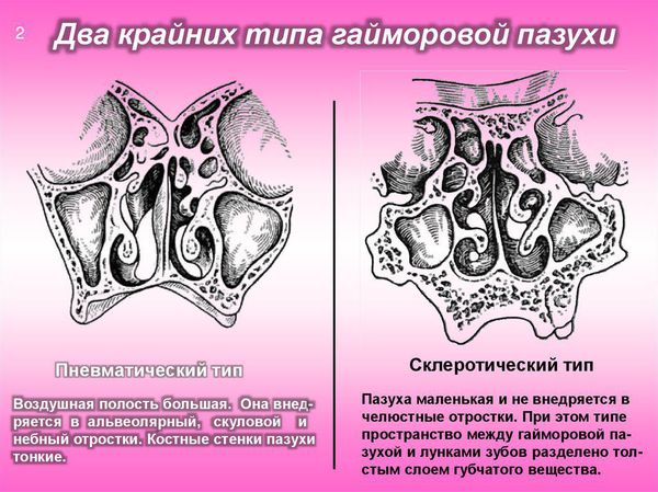 Два типа верхнечелюстных пазух