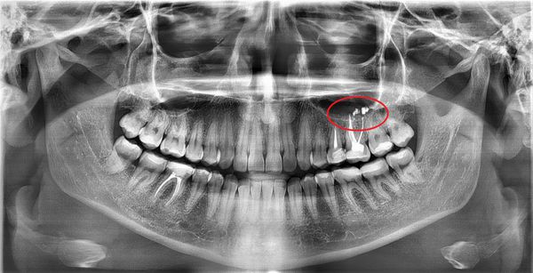 Пломбировочный материал в пазухе на ортопантомограмме