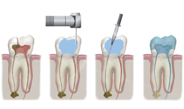 Эндодонтическое лечение корневых каналов