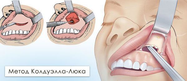 Радикальная гайморотомия по Колдуэллу — Люку