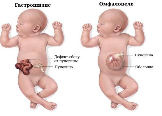 Гастрошизис и омфалоцеле