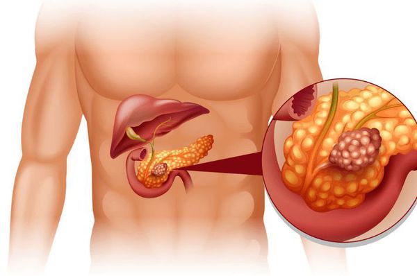 Новообразование поджелудочной железы