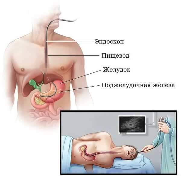 Эндосонография