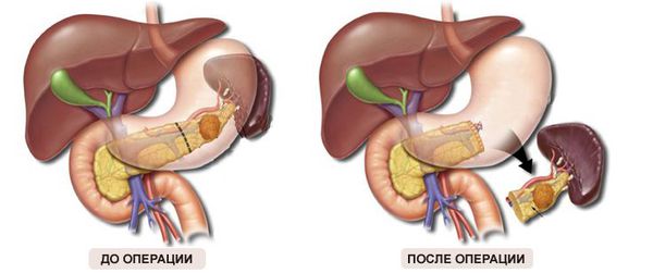 Удаление хвоста поджелудочной железы и селезёнки