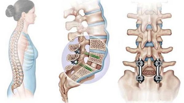 Транспедикулярная фиксация