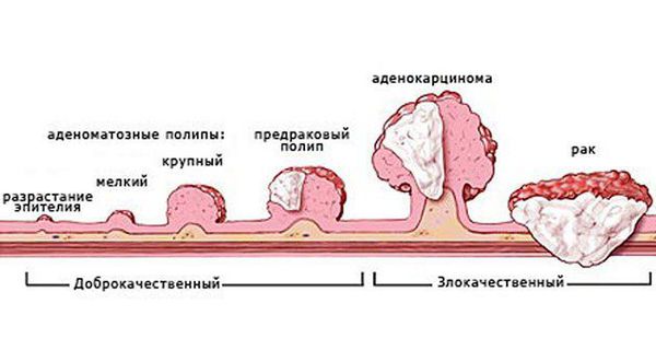 Новообразования толстой кишки