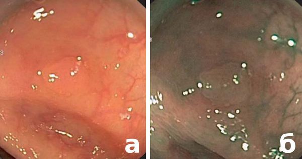 Эндоскопия, проводимая при освещении поверхности слизистой оболочки белым светом (а) и узкоспектральная эндоскопия (б)