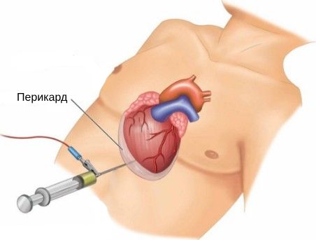 Перикардиоцентез