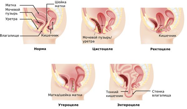 Типы пролапса тазовых органов