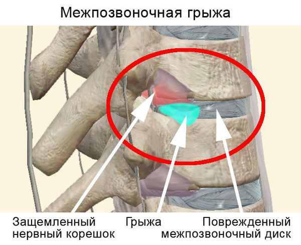 Грыжа межпозвоночного диска