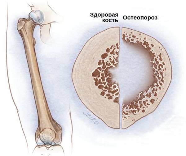 Снижение плотности костей