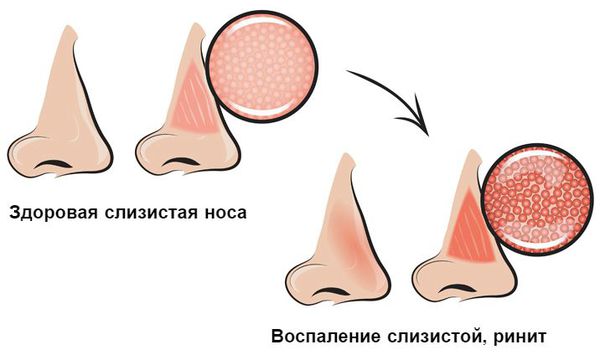 Воспаление слизистой носа