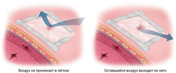 Окклюзионная повязка