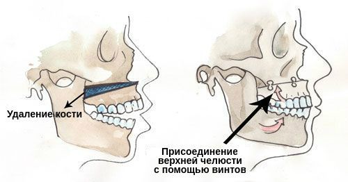 Операция по исправлению открытого прикуса