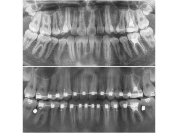 ОПТГ до и после установки брекет-системы и микровинтов