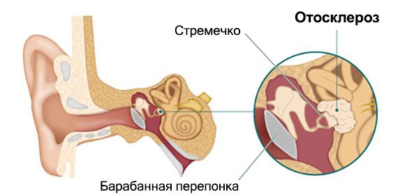 Отосклероз