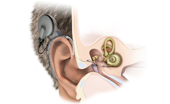 Кохлеарная имплантация