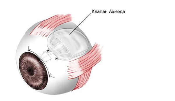 Установка клапана Ахмеда