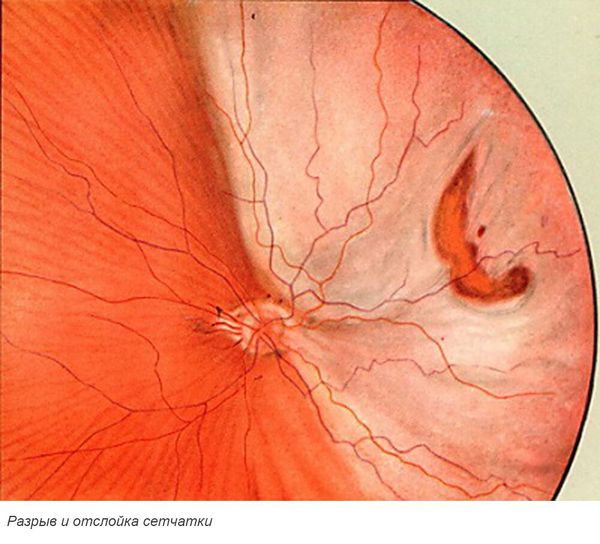 Разрыв и отслоение сетчатки