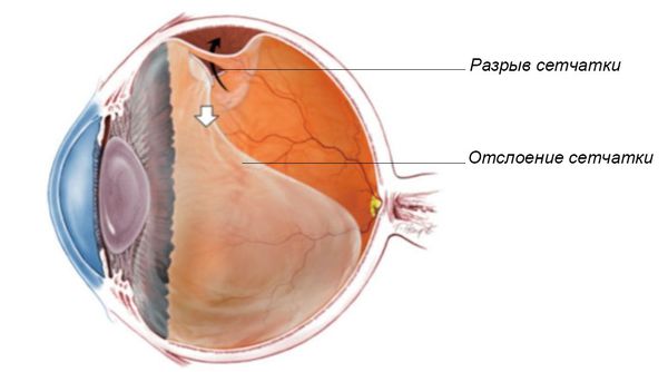 Разрыв, отслойка сетчатки