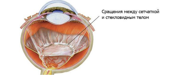 Тракционное отслоение сетчатки