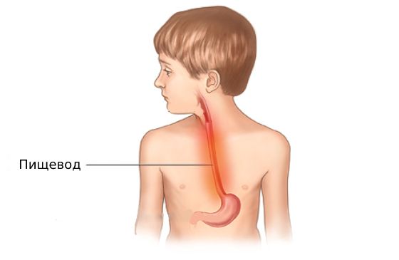 Ожог пищевода