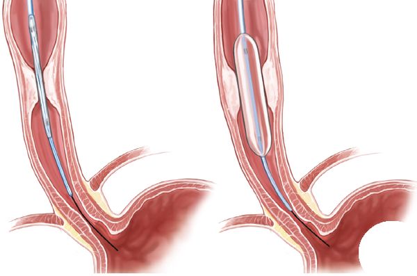 Бужирование пищевода