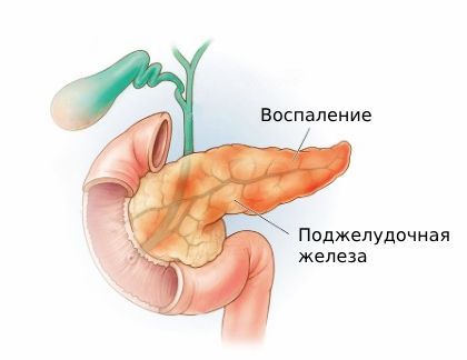 Панкреатит