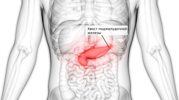Хвост поджелудочной железы