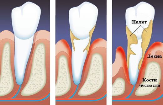 Налёт - причина парадонтоза