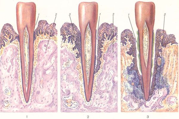 Стадии пародонтоза