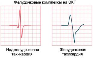 Желудочковые комплексы на ЭКГ