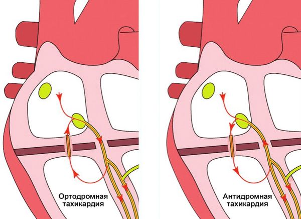 Ортодромная и антидромная тахикардия