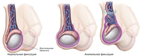 Аномальная фиксация яичка влагалищной оболочкой