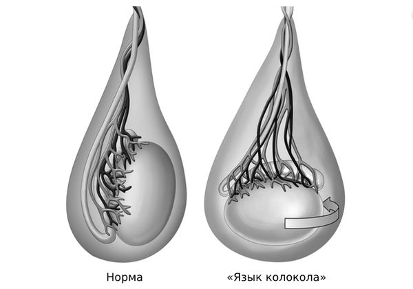 Деформация по типу «языка колокола»