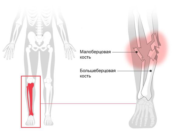 Перелом голени