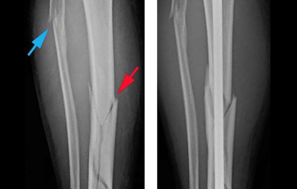 Рентгеновский снимок при переломе голени