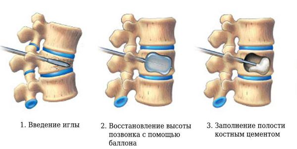 Кифопластика