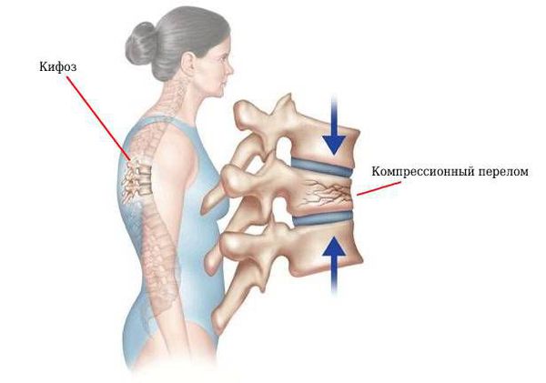 Компрессионный перелом позвонка усиливает кифоз