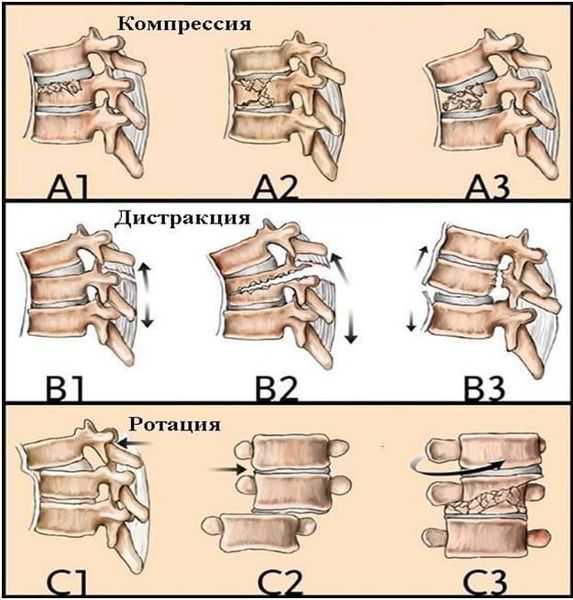 Универсальная классификация переломов